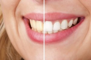 Teeth Whitening Northeast Philadelphia