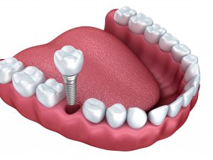 Dental Implants Northeast Philadelphia