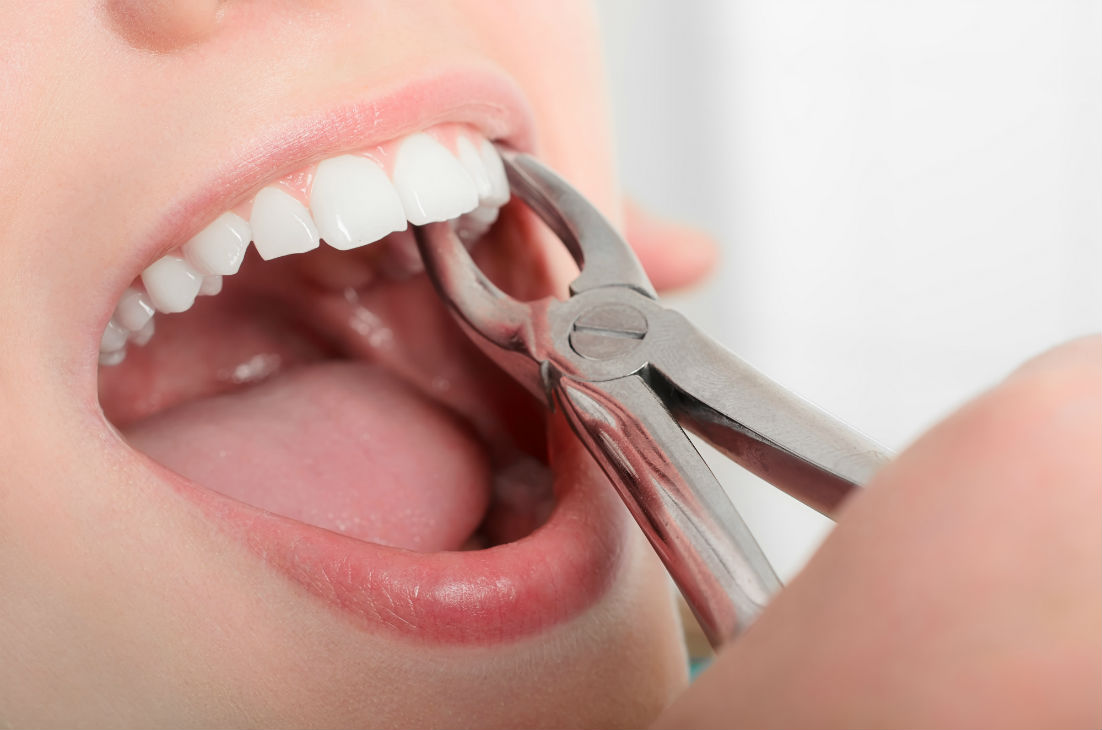 Tooth Extraction Philadelphia