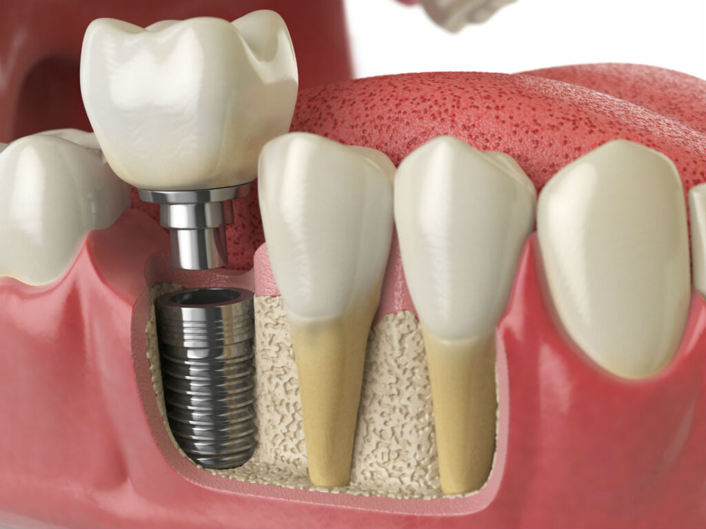 Dental Implants Philadelphia
