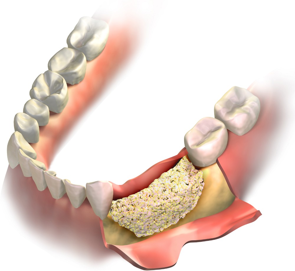 Bone Grafting Philadelphia, PA